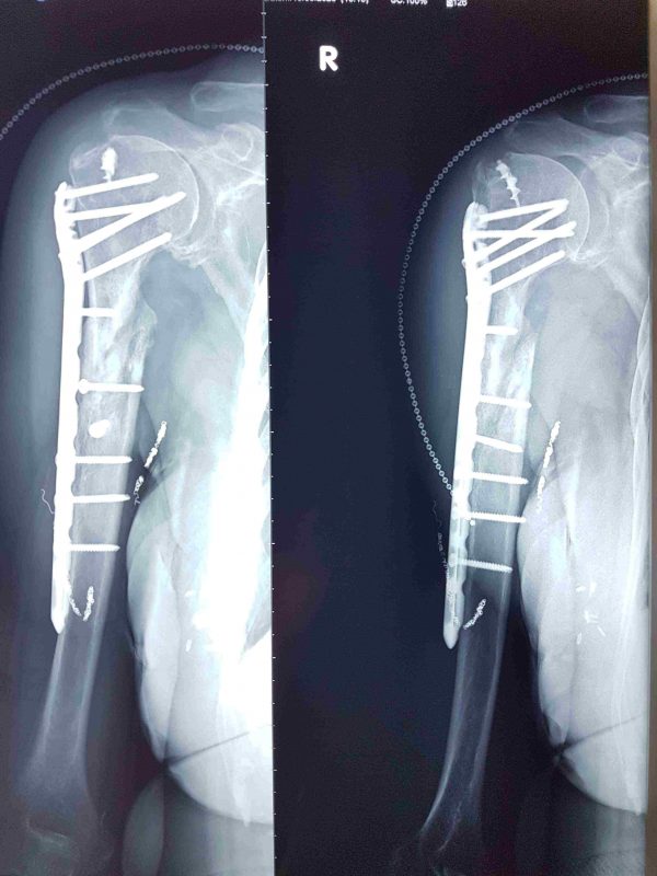 Humerus kl, 